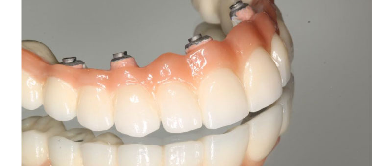 implantes dentales en Savanna Clínica Odontológica