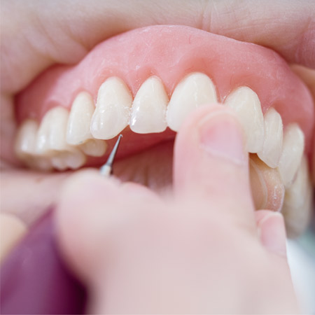 Limpieza dental en Savanna Clínica Odontológica