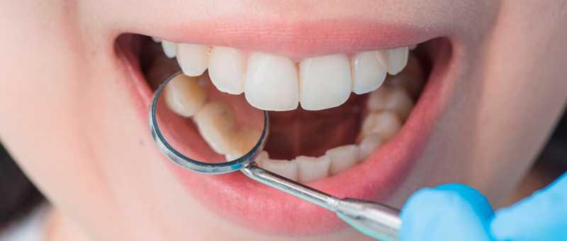 Servicio de limpieza dental en Savanna Clínica Odontológica